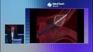 AQUAHeart: Steam-Powered Cardiac Ablation Technology | MedTech Malta 2025