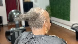 My mother has alopecia.