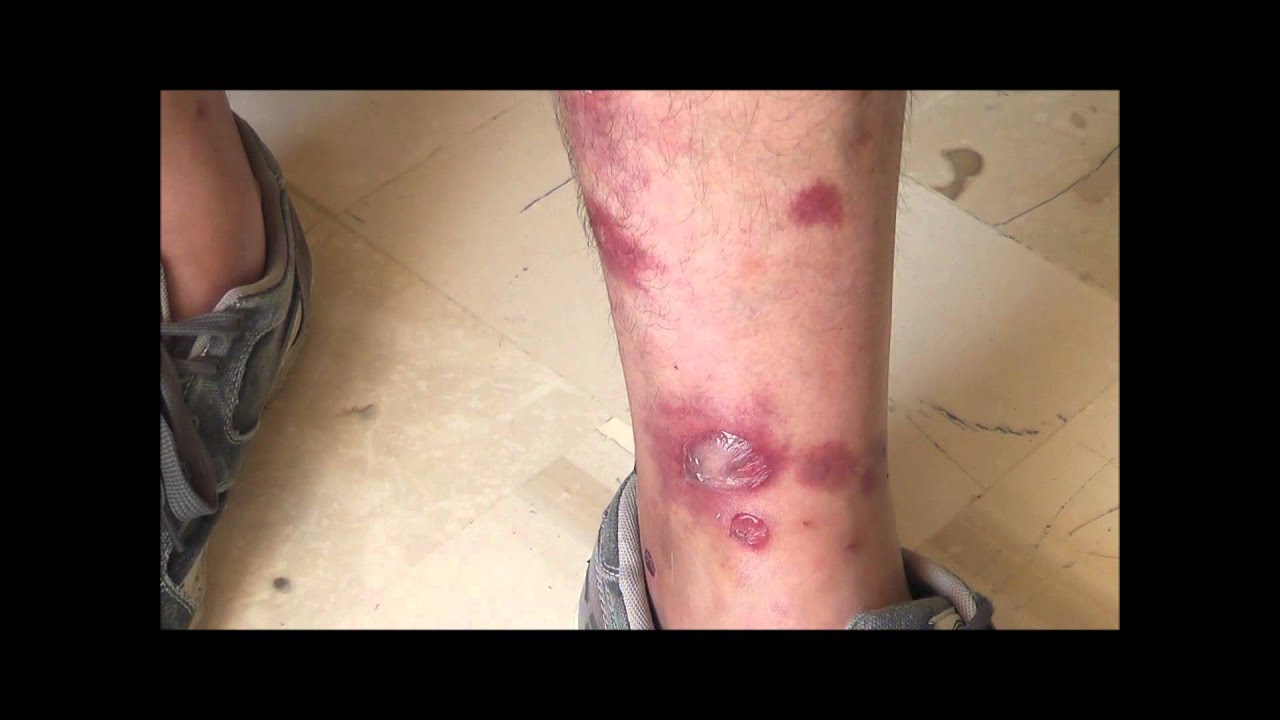 leg and Ankle mosquito bites, before and 36 hours after treatment - YouTube