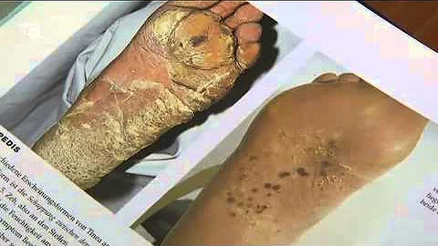 Come mai la pianta del piede si spella?
