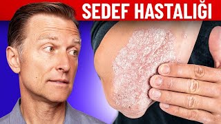 Sedef Hastalığı Tedavisi | Dr.Berg Türkçe Resimi