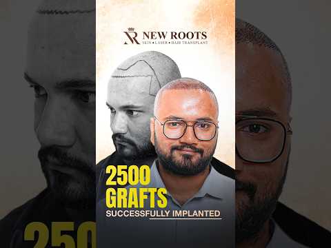 2500 Grafts Hair Transplant in Kolkata | Hair Transplant Cost and Best Results #hair #shorts