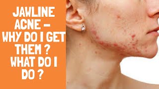 Jawline Acne - Why do I get Acne on my Jawline & how do I manage them ?