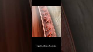 Peripheral Vascular Disease | MedicoMind #3danimation #PVD#PeripheralVascularDisease#VascularHealth