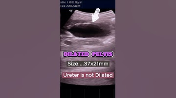 Ultrasound Renal Pelvic Ureteric Junction [ PUJ ] Obstruction  #ultrasound #kidney