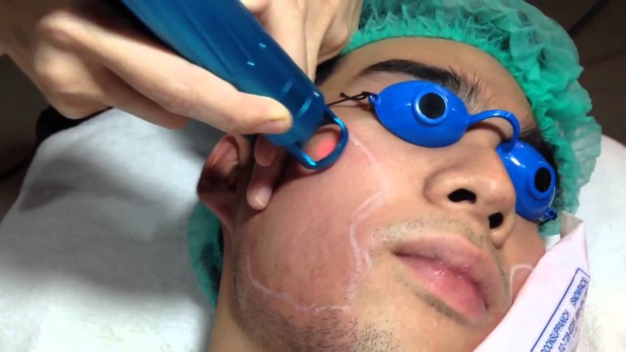 คลิปเลเซอร์กำจัดขน(บนหน้า)อย่างถาวร - โดดเด่นดอทคอม ศัลยกรรม เสริมจมูก  รีวิวศัลยกรรม ศัลยกรรมจมูก ทำจมูกที่ไหนดี ตาสองชั้น เสริมคาง ปากบาง  เสริมหน้าอก ดูดไขมัน ร้อยไหม ศัลยกรรมเกาหลี