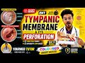 TYMPANIC MEMBRANE | Tympanic Membrane Perforation | ENT LECTURES #otorhinolaryngology #mbbslectures 