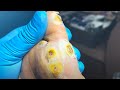 There Are Many Contagious Warts On The Soles Of My Feet, And They Need Urgent Treatment