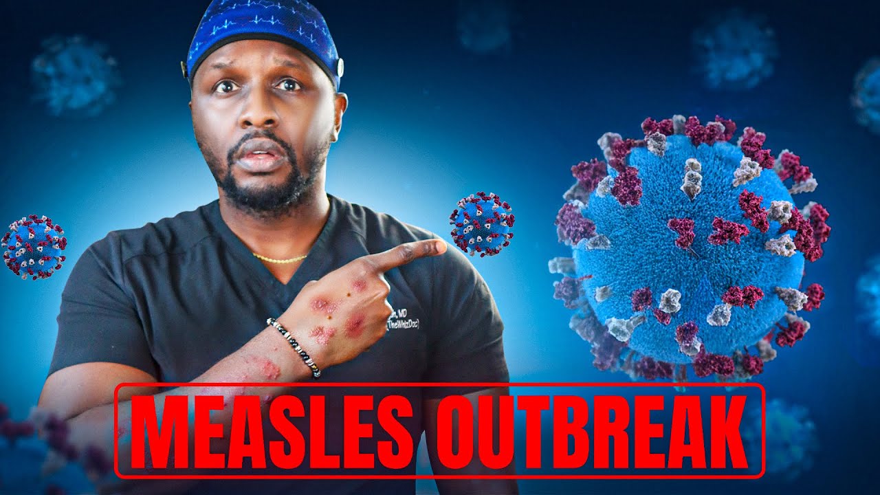 Measles Outbreak: What You Need to Know to Stay Safe! - YouTube