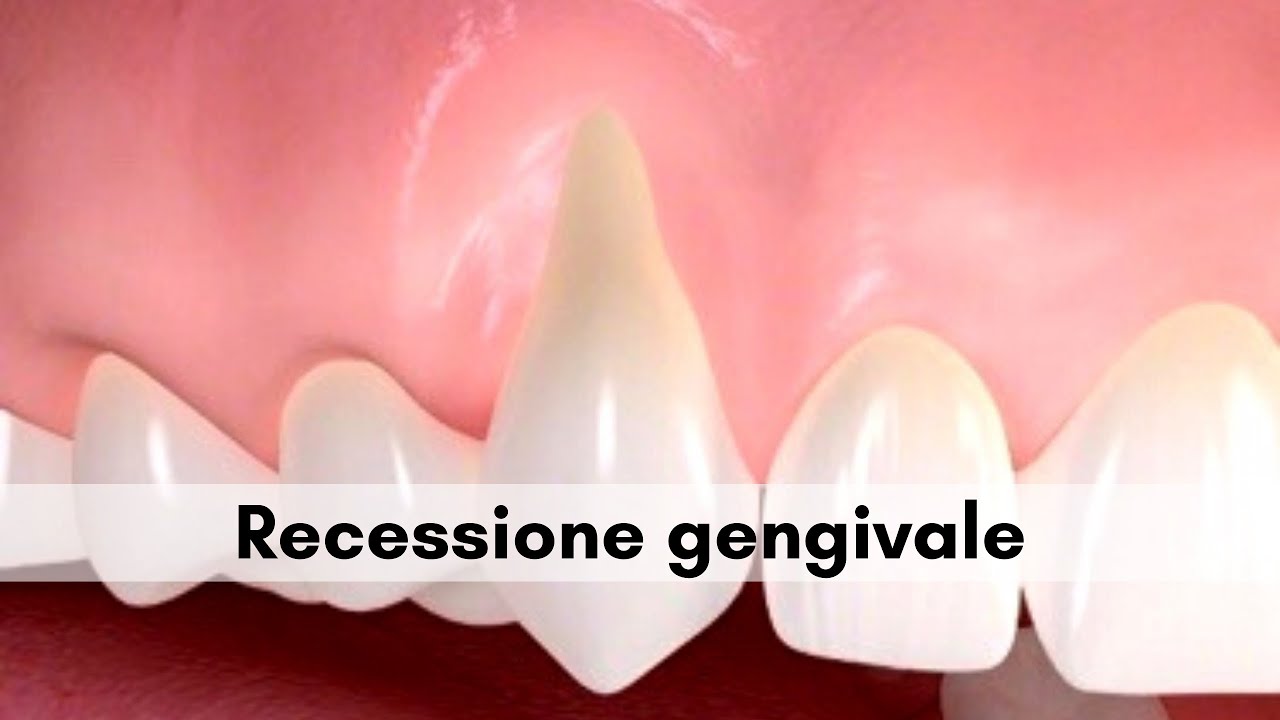 Recessione gengivale