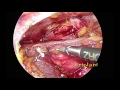 Thoracoscopic (VATS) Thymectomy for thymoma : anatomy and managing bleeding from innominate vein