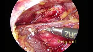 Thoracoscopic (VATS) Thymectomy for thymoma : anatomy and managing bleeding from innominate vein