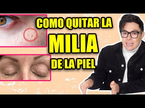 Video: ¿Milia desaparecerá por sí sola?