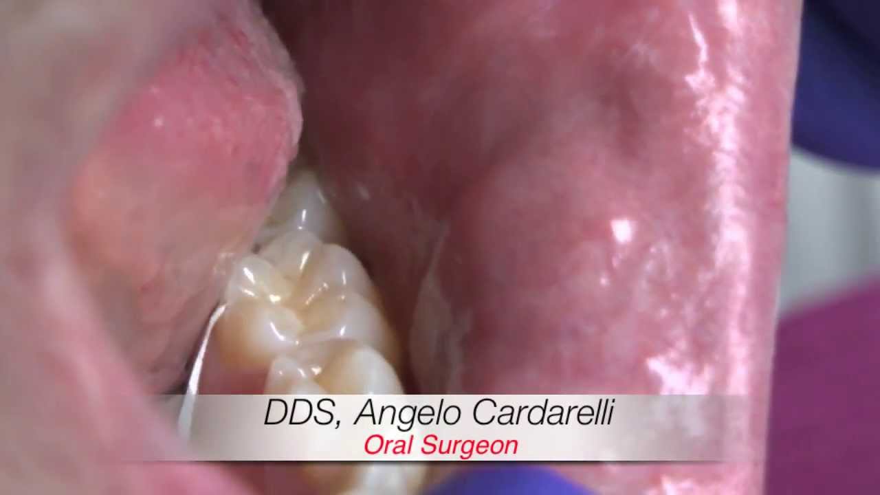 Laser treatment of fibroma of the oral cavity YouTube