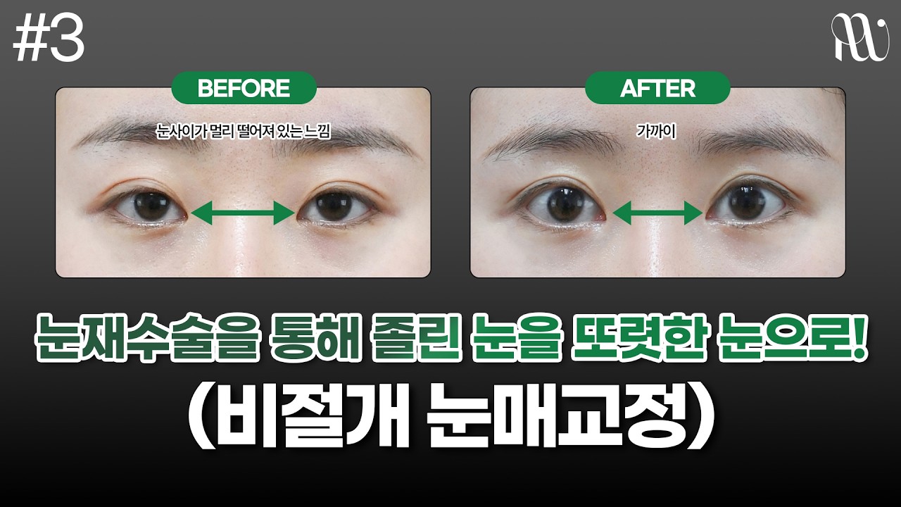 재수술을 통해 졸린 눈을, 또렷한 눈으로!