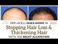 How PRP and ACell Stops and Reverses Hair Thinning in Over 99% of Cases with the Right Algorithm