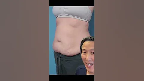 Tummy Tuck REVEAL! #shorts #tummytuck