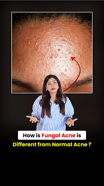 Fungal Acne vs Normal Acne – Kaise Pehchaanein? | Dermatologist Explains