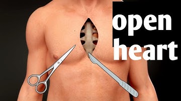 How Open Heart Surgery Works | Step-by-Step Medical Animation