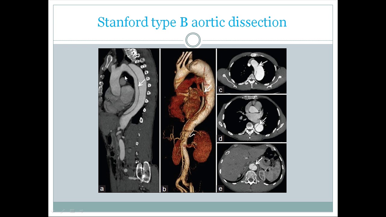 Cardiac Ct Scan 3d Ct Angiogram Basic Overview Use