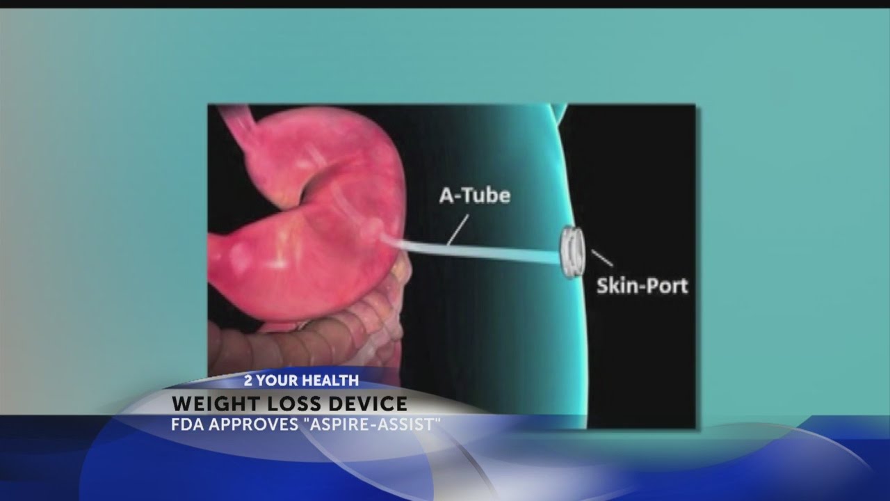 FDA approves new weight-loss device - YouTube