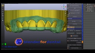 Gengivectomy Guide B4D