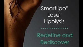 Laser liposuction to remove fat NYC | SmartLipo Q & A with Dr. Bruce Katz