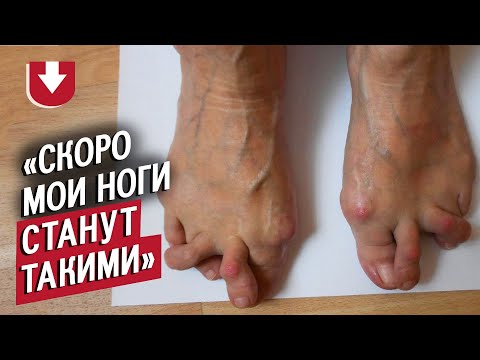 У меня ревматоидный артрит (очень жутко): Маша | Быть молодым