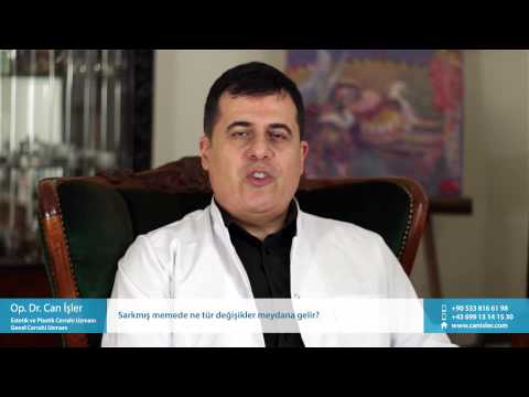 Sarkmış Memede Ne Tür Değişikler Meydana Gelir? - Op. Dr. Can İşler