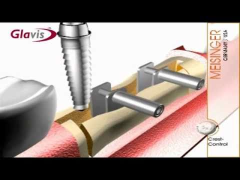MEISINGER - Crest Control