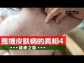 真难缠！来戳穿带状疱疹的三个花招 20240330 难缠皮肤病的真相4 |《健康之路》CCTV科教