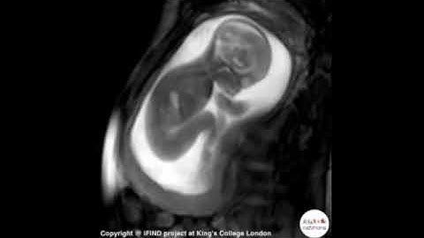 Incredible Scan Of Baby Moving In The Womb