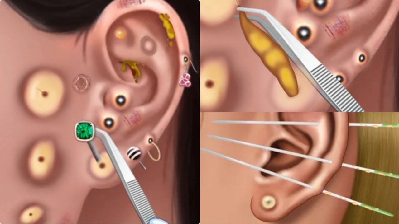 ASMR EAR Cleaning Blackhead Removing Pus Ear Infaction Treatment #asmr