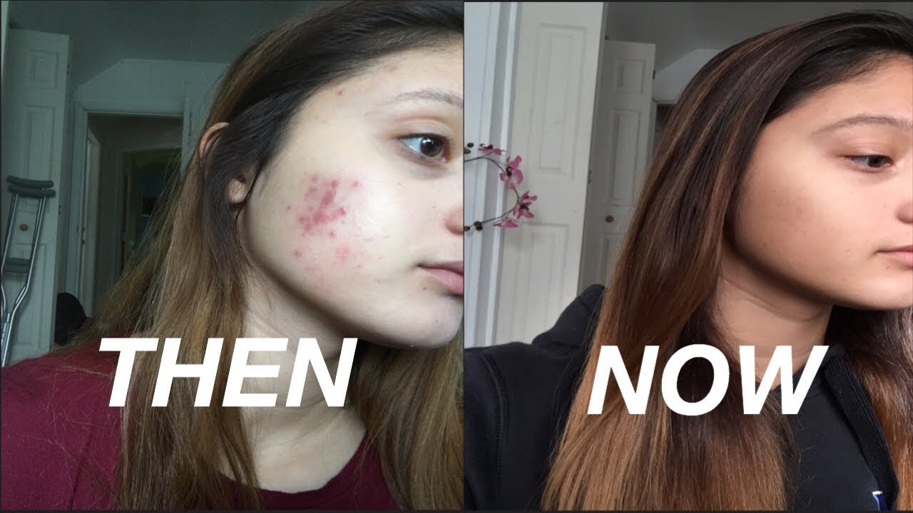 HOW I GOT RID OF MY ACNE & ACNE SCARRING !!! - YouTube
