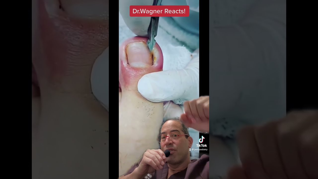 SUPER ANGRY INGROWN TOENAIL WITH ABSCESS Shorts Ingrown Toenail