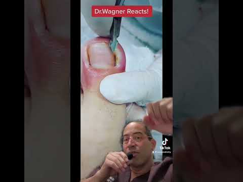 SUPER ANGRY INGROWN TOENAIL WITH ABSCESS Shorts Ingrown Toenail