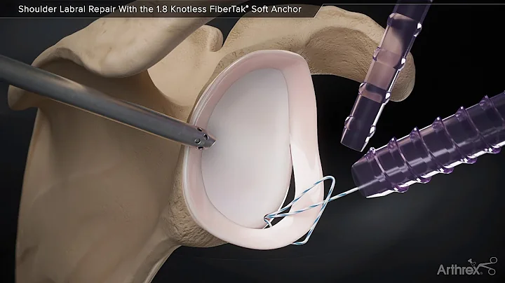 Shoulder Labral Repair With the 1.8 Knotless FiberTak® Soft Anchor