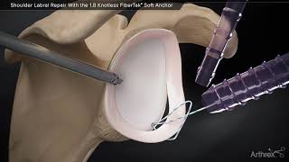 Shoulder Labral Repair With the 1.8 Knotless FiberTak® Soft Anchor screenshot 4
