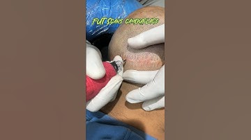 Scalp micropigmentation transformation of the month, regain your confidence #scalpmicropigmentation