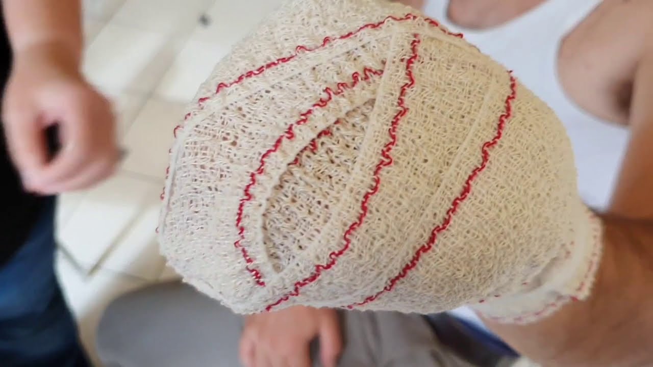 Verbandleer: stompverband (tweede wijze)