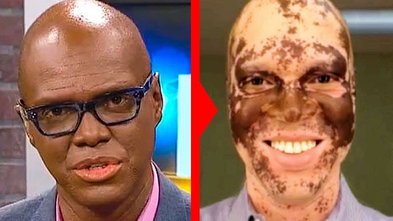 Strange Syndromes Leaky Brain Syndrome vrogue.co