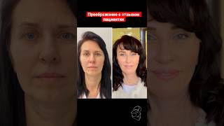 Голливудский фейслифтинг. Подтяжка лица. Пластический хирург Татьяна Романовская