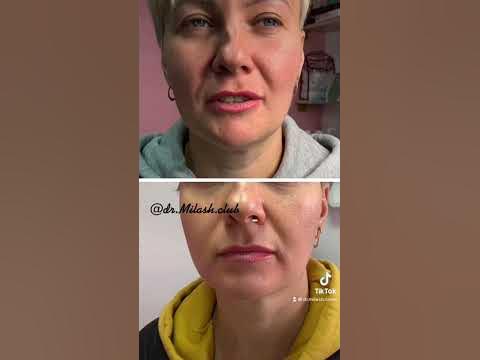 Липолитики для коррекции второго подбородка. Всего 1-3 сеанса и Вы ...
