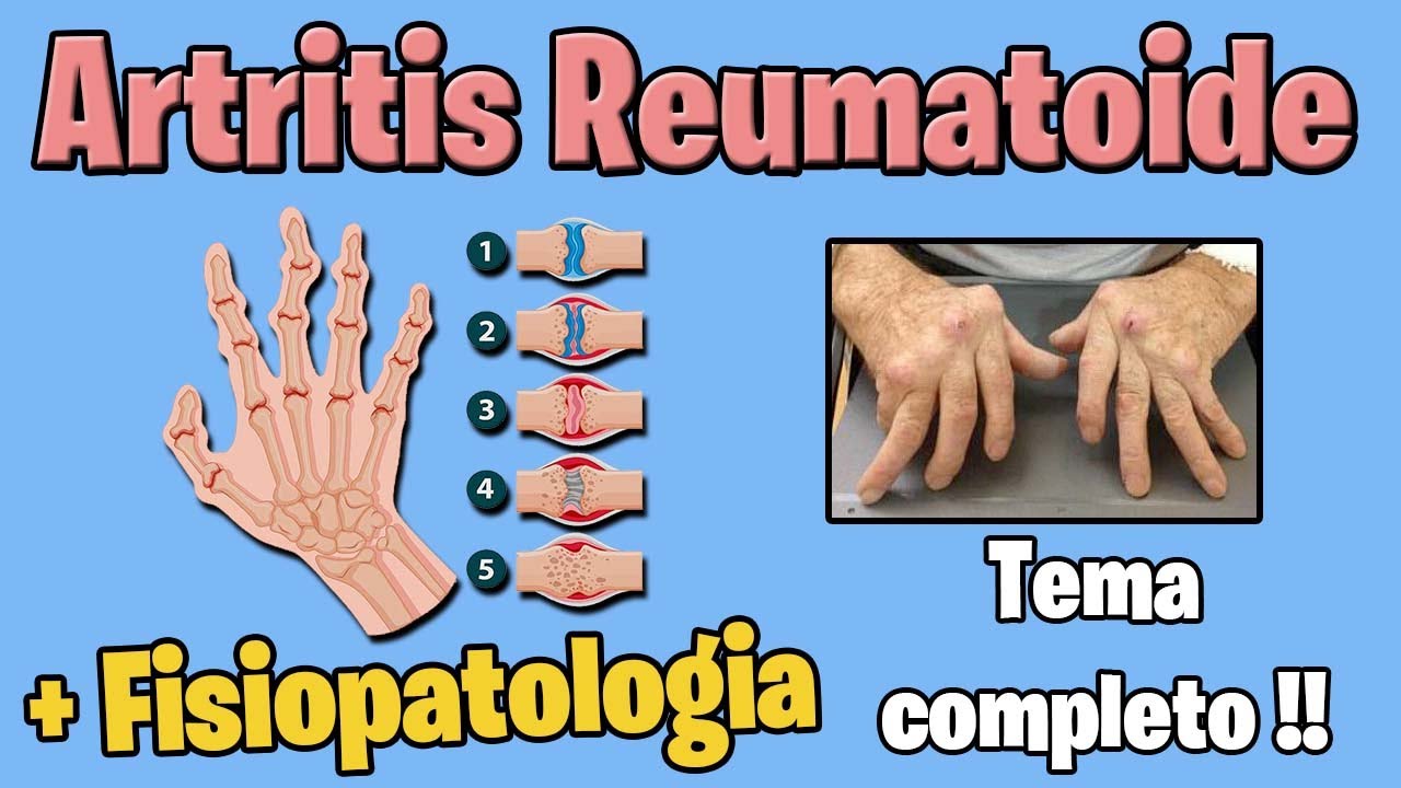 ARTRITIS REUMATOIDE | sintomas tratamiento | FISIOPATOLOGIA