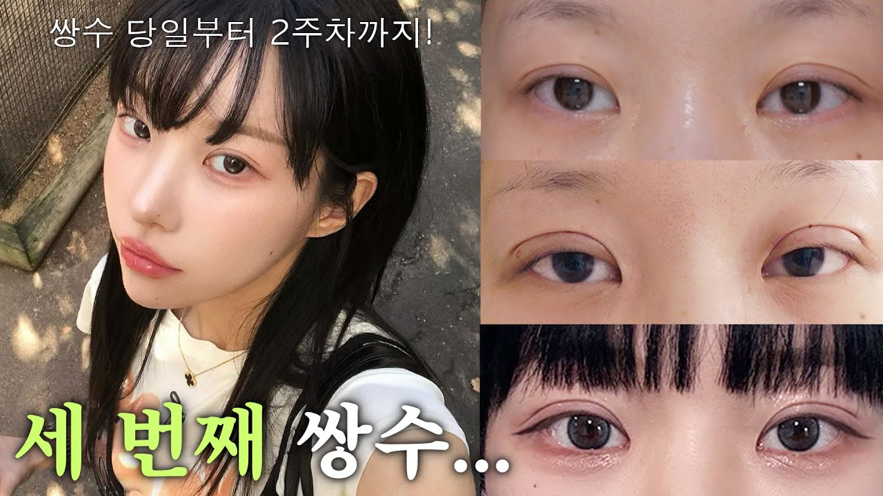 저 드디어 재재수술 했습니다..👀✨세 번째 쌍수 후기 Vlog💘feat.이렇게 붓기 없는 수술은 처음이야..재수술한 이유..? | 소윤Soyoon