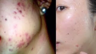 HOW TO GET RID OF ACNE SCARS! BANISH.COM