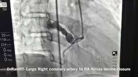 DrRaviRT- Large Coronary Artery Fistula (RCA to RA) device closure