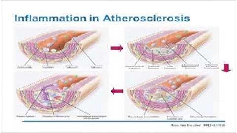Management of Co-morbidities: Cardiovascular Metabolic Complications