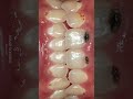 Amazing teeth restoration with veneers #laminate #veneers #koreadentist
