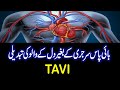 Heart valve replacement without bypass surgery             tavi